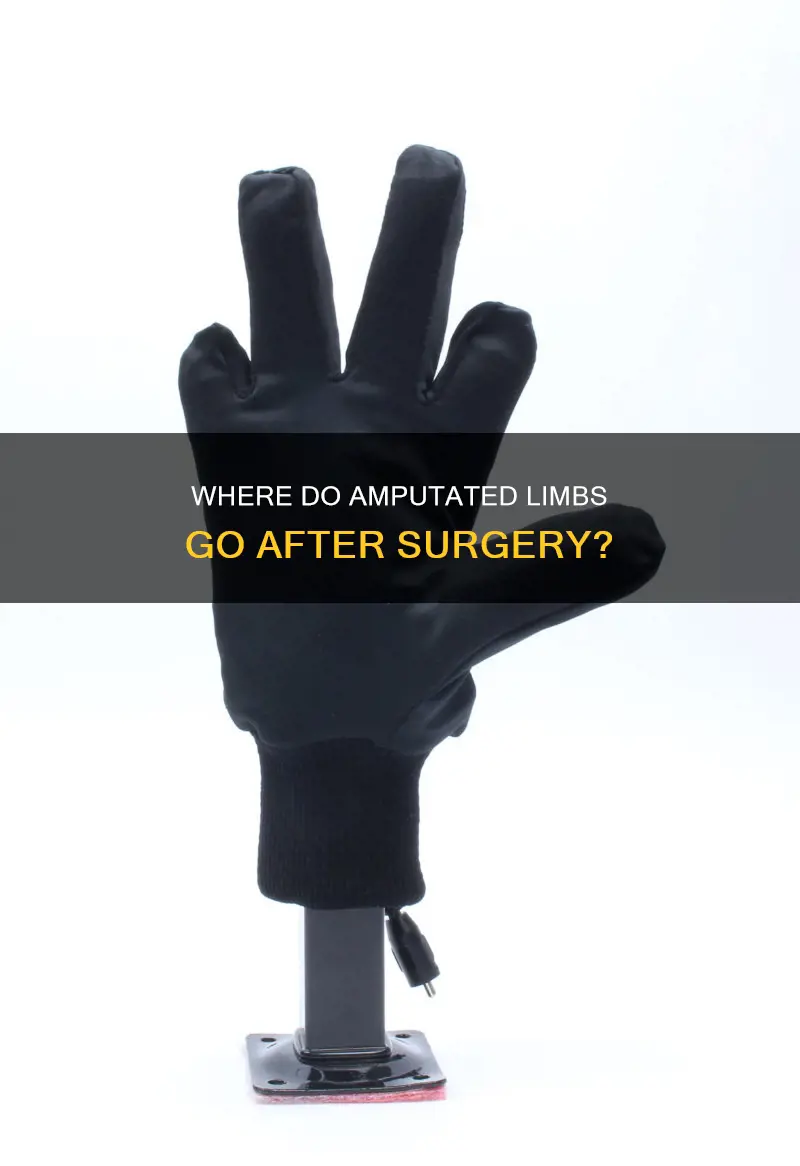 what do hospital do with amputated limbs