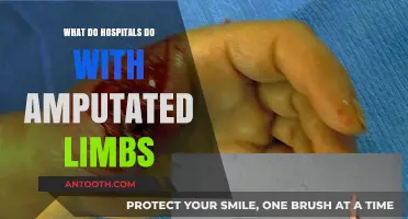 The Mystery of Amputated Limbs: Where Do They Go?
