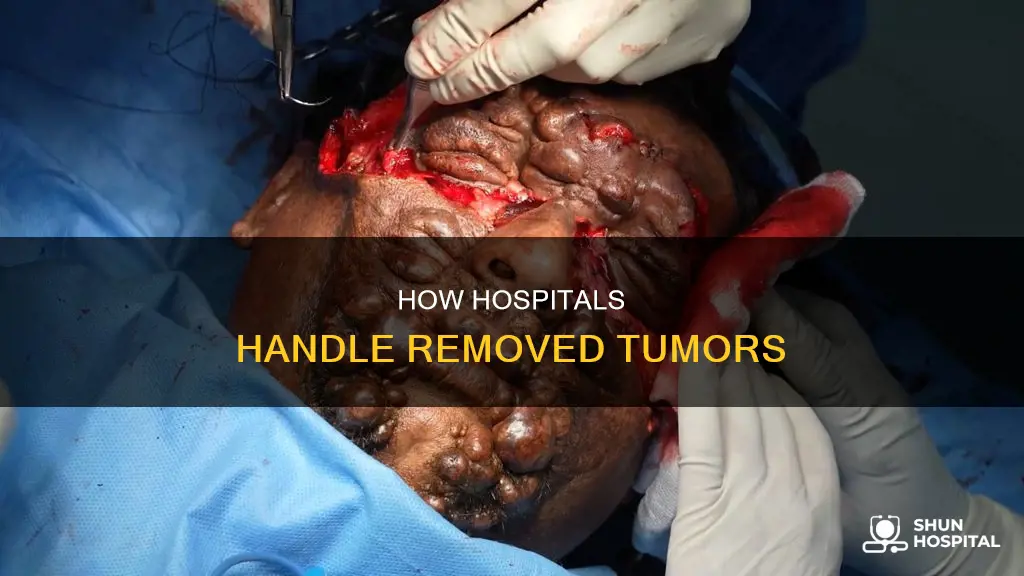 what do hospitals do with removed tumors