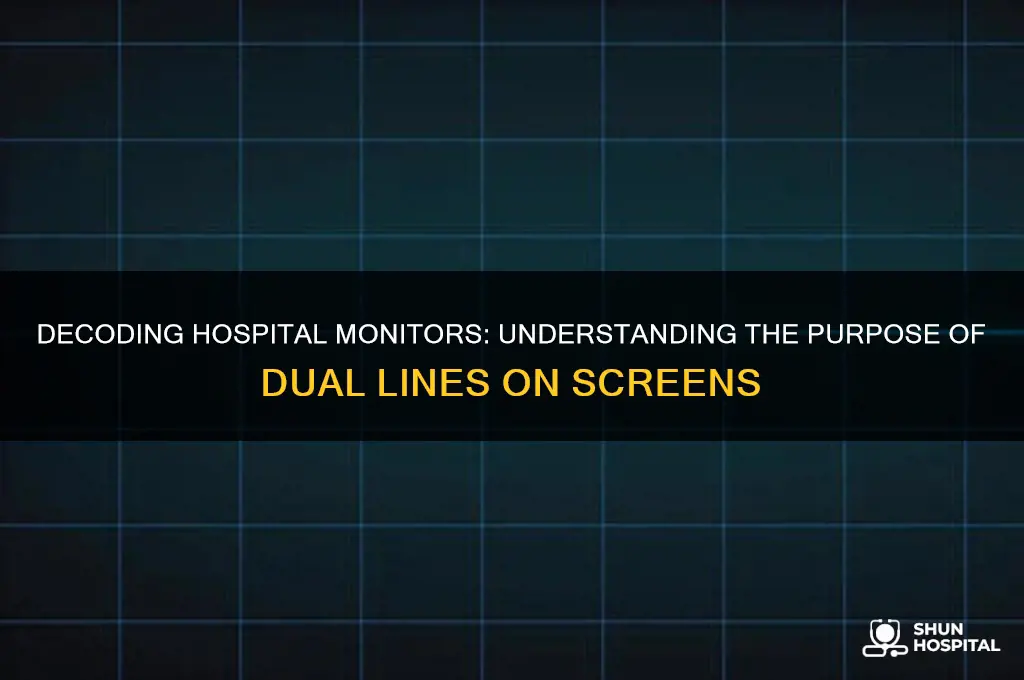 what do the two lines show on a hospital screen