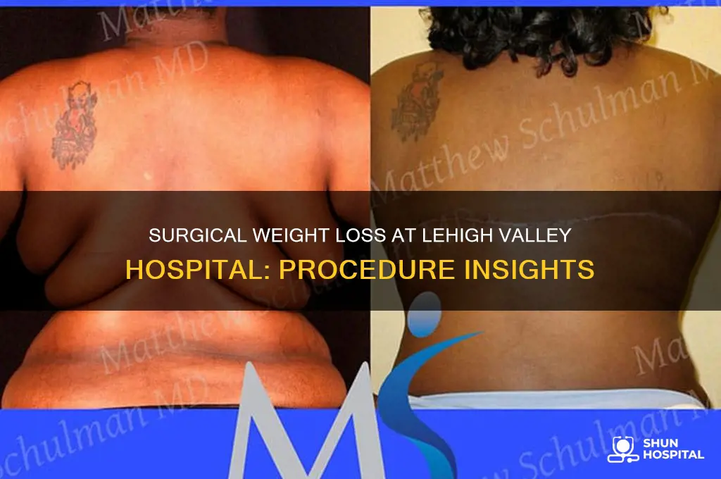 what happens during surgical weight loss physical lehigh valley hospital