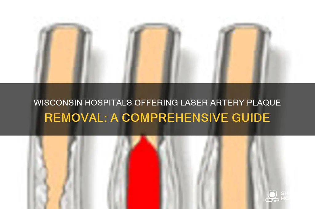what hospitals in wi do laser artery plaque removal