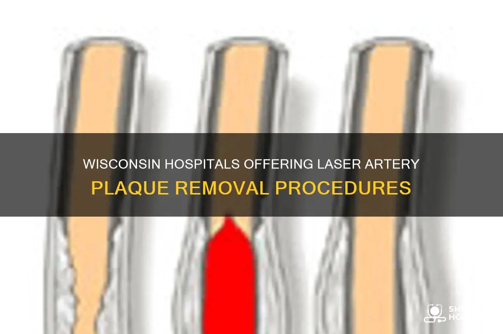 what hospitals in wi do lazer artery plack removal