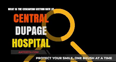 Central DuPage Hospital's Cesarean Section Rate: What You Need to Know