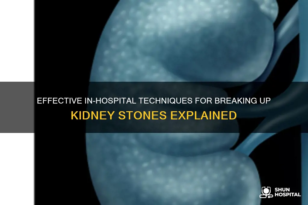 what is the in-hospital method for breaking up kidney stones