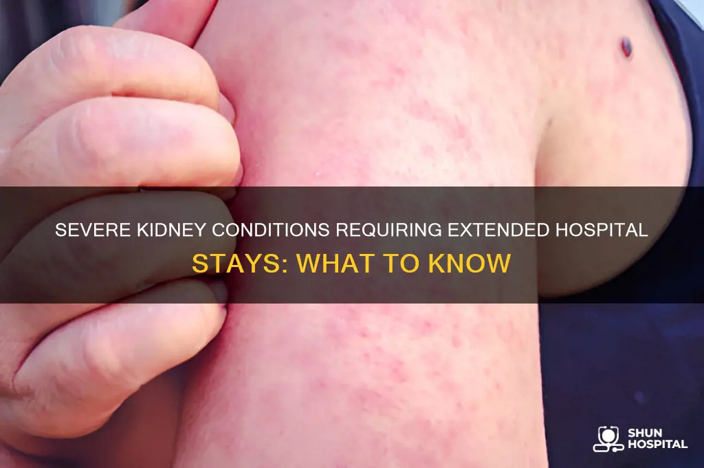what kidney problums keeps you in the hospital for week