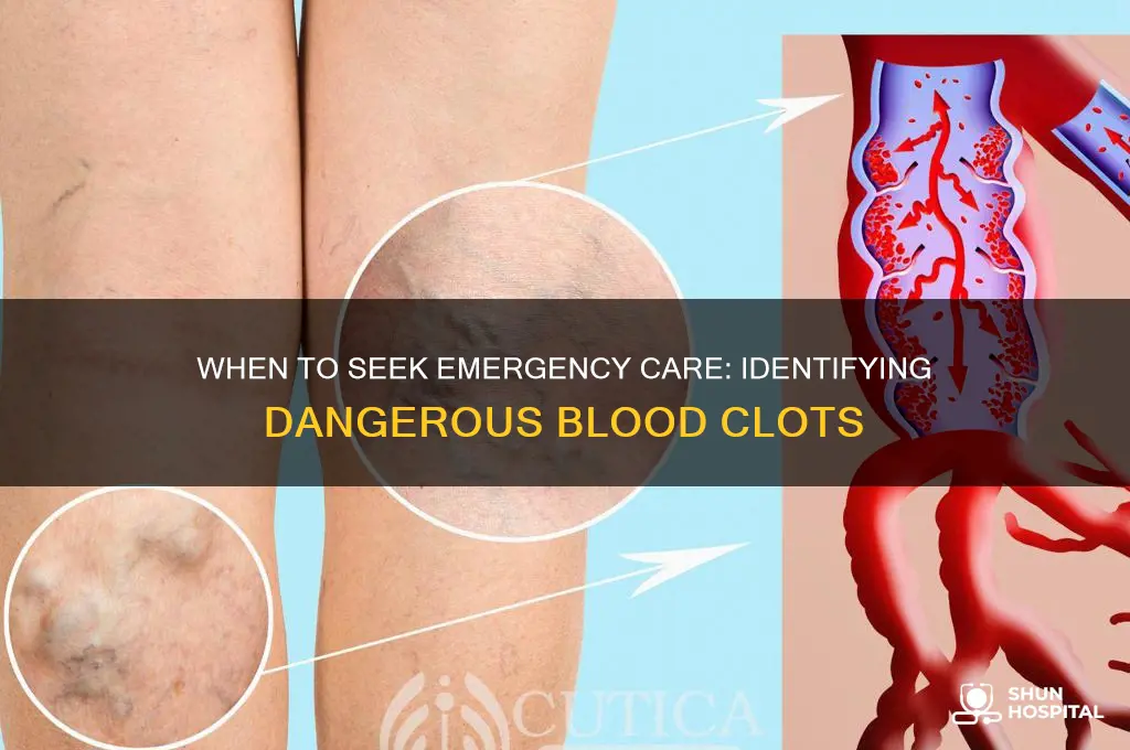 what kind of blood clots send you to the hospital