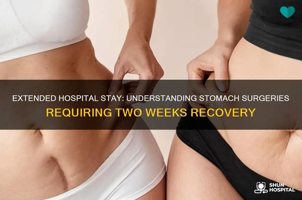 what stomach surgery keeps you in hospital for 2 weeks