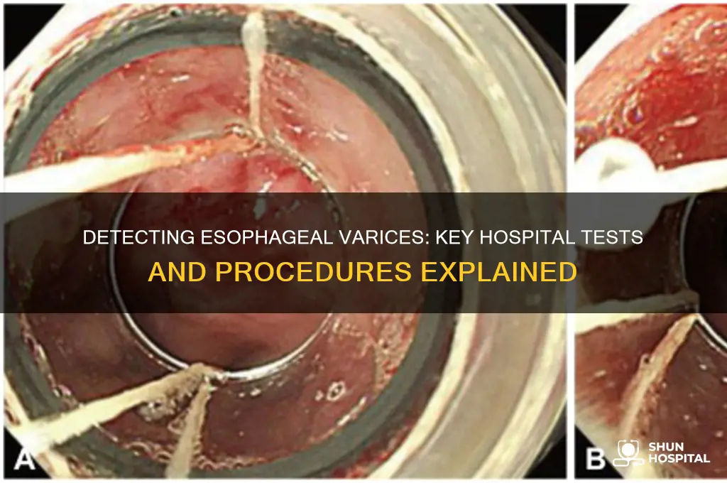 what test in a hospital to detect esophageal varices