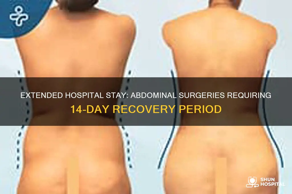 what type of abdominal surgery requires 14 day hospital stay