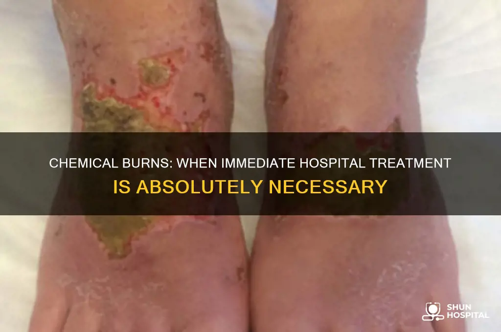 what type of chemical burns always require hospital treatment