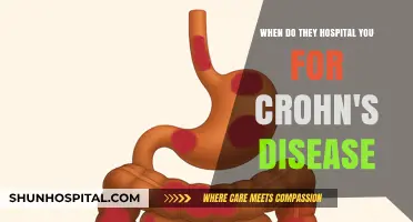 When is Hospitalization Necessary for Crohn's Disease Flare-Ups?