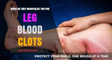 When Are Leg Blood Clots Serious Enough for Hospitalization?