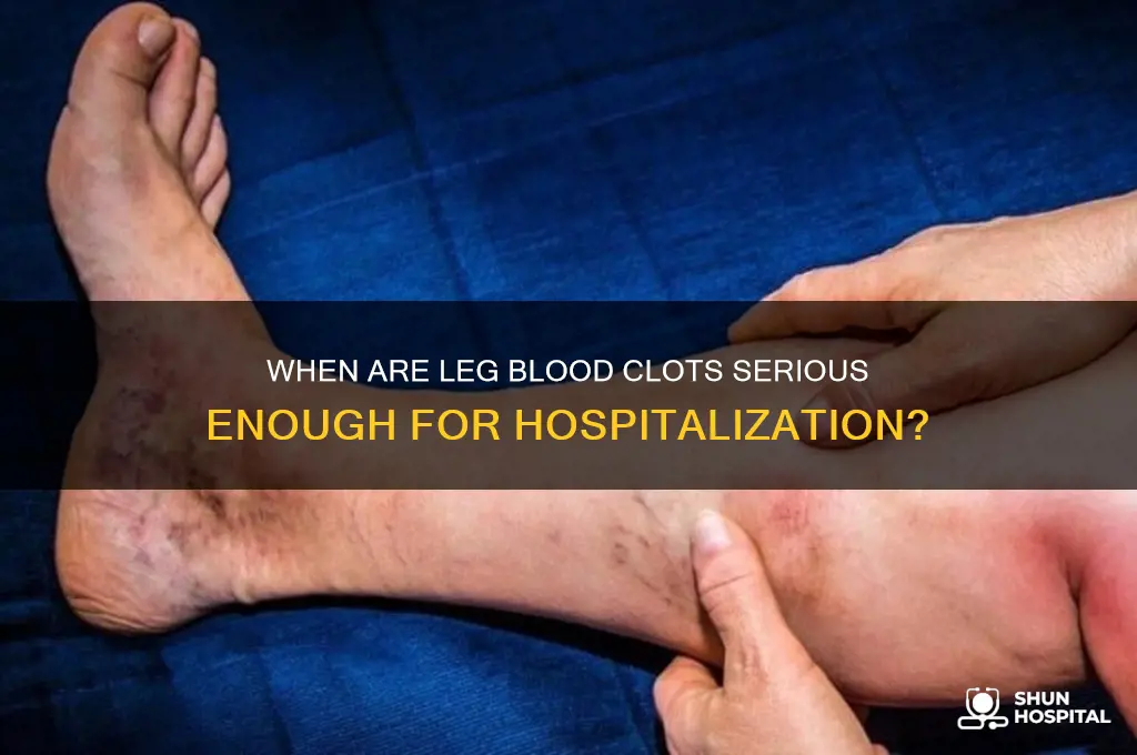 when do they hospitalize you for leg blood clots