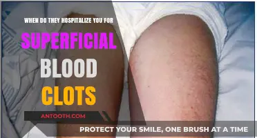 When Are Superficial Blood Clots Serious Enough for Hospitalization?