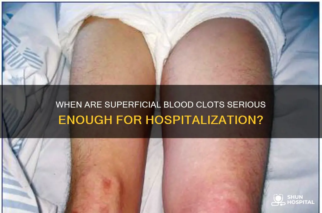 when do they hospitalize you for superficial blood clots