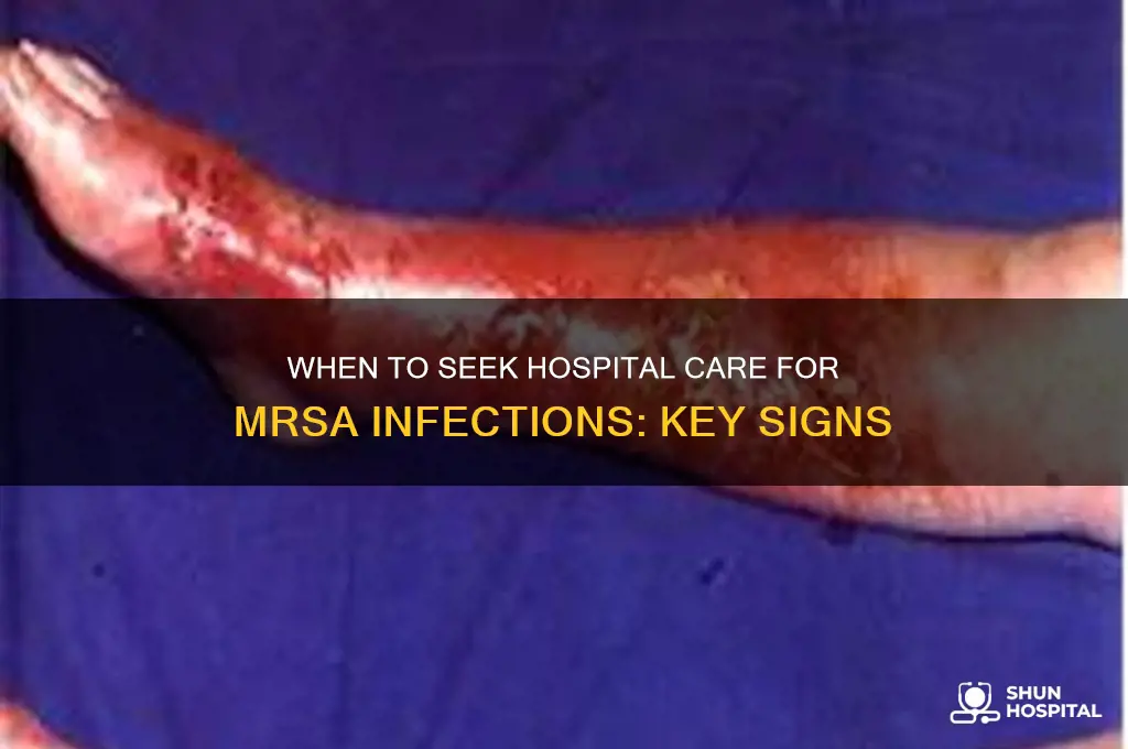 when do you need hospital with mrsa