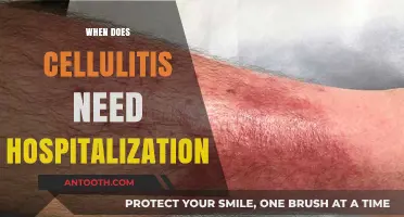 When Cellulitis Requires Hospital Care: Recognizing the Signs