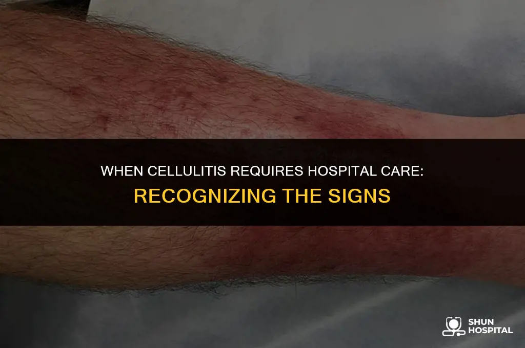 when does cellulitis need hospitalization