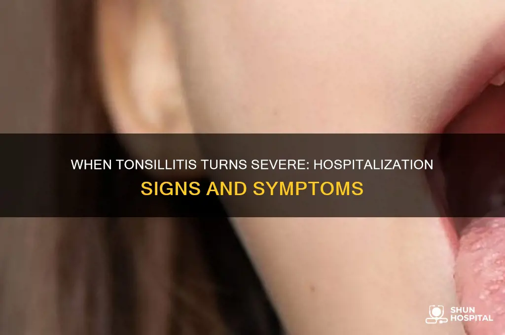 when does tonsillitis require hospitalization