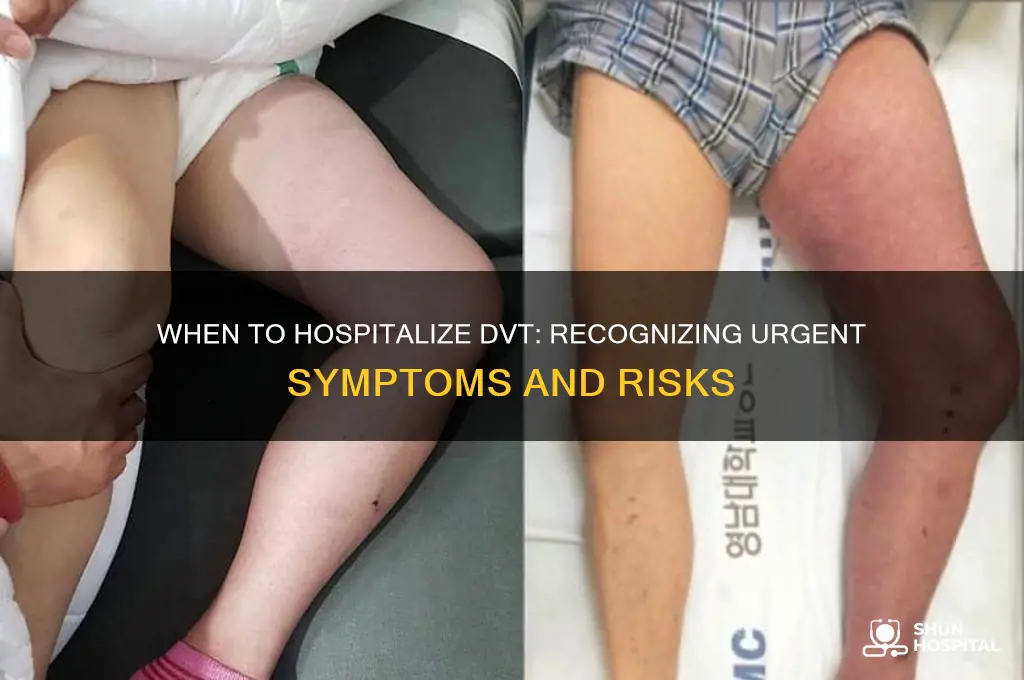 when to hospitalize dvt