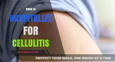 When to Hospitalize for Cellulitis: Recognizing Severe Symptoms and Risks