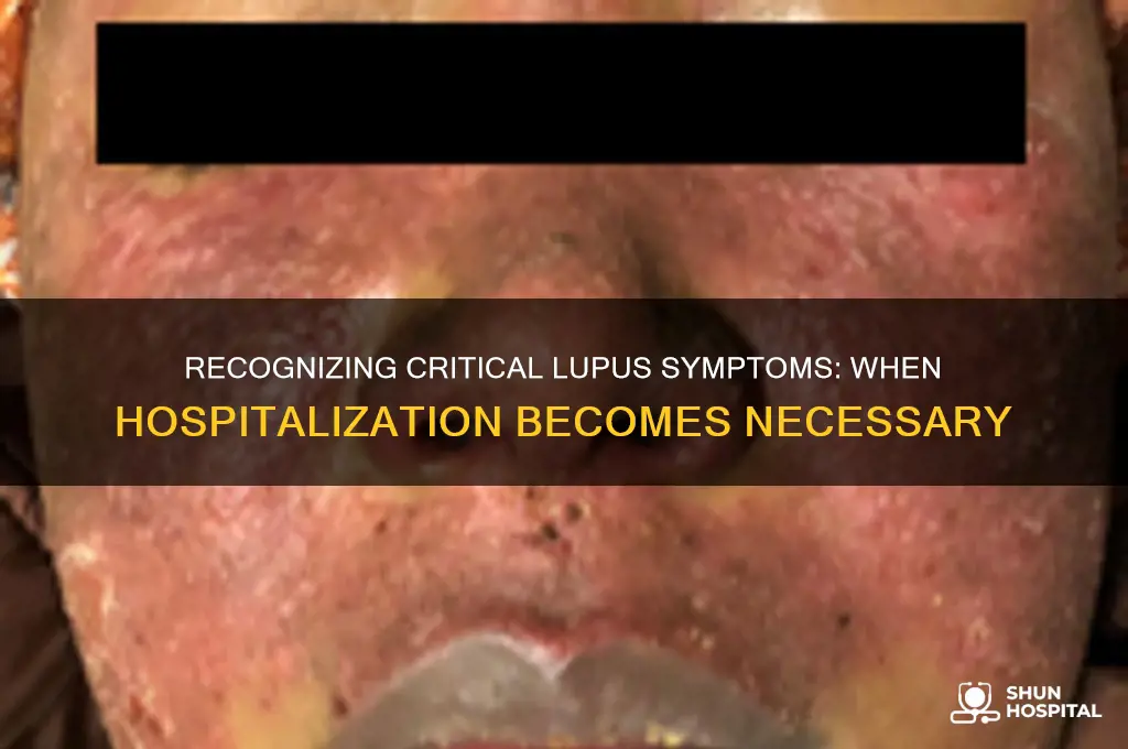 when to hospitalize for lupus