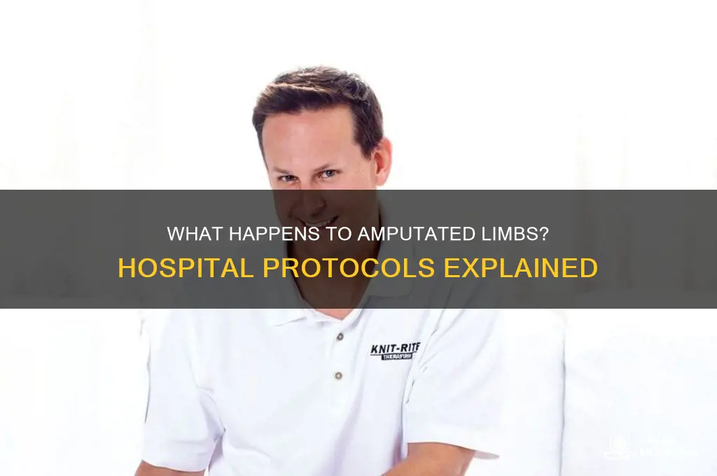 where do hospitals put amputated body parts